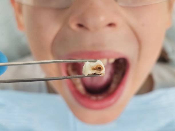 Best Emergency Dental Extractions in Brookwood, AL